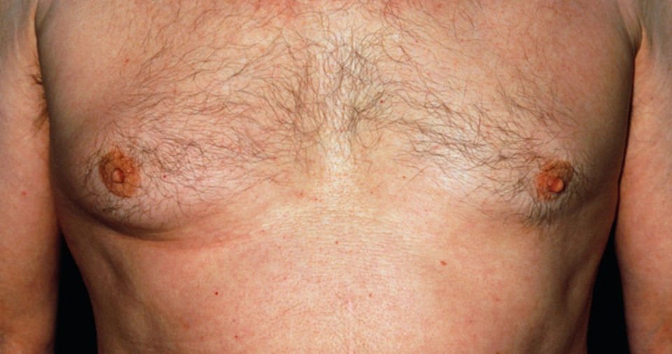 Male Breast Cancer