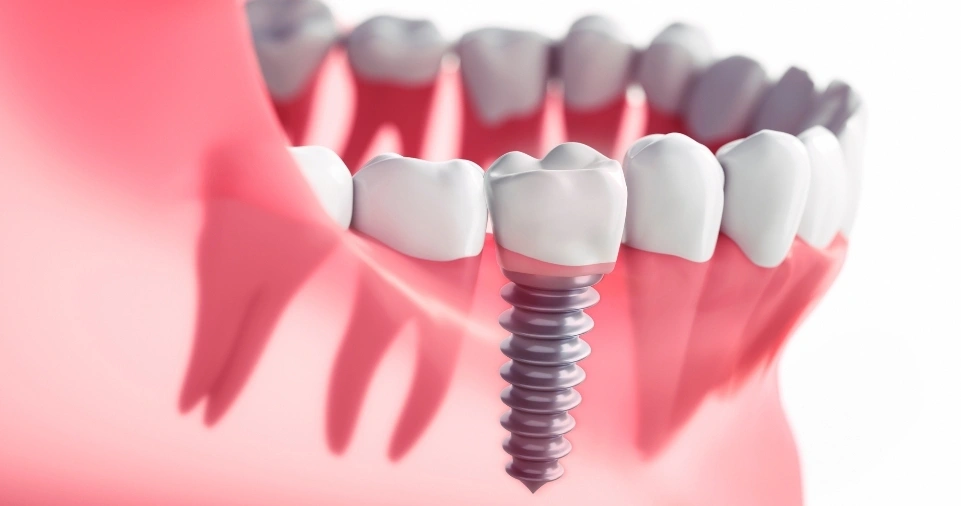 Dental Implant